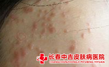 长春哪里治疗扁平疣
