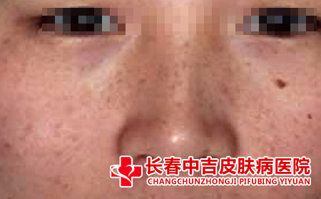 长春哪里能看雀斑