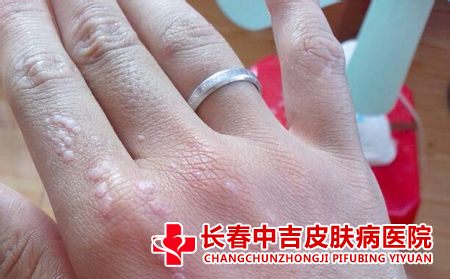 长春哪里治疗扁平疣