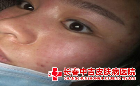 长春哪里治疗痤疮