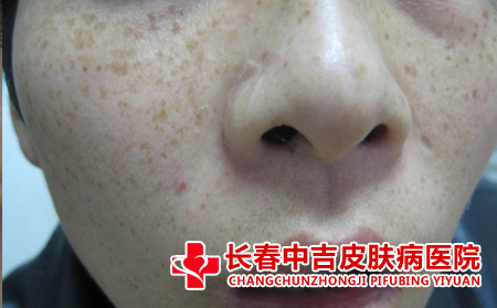 长春哪里治疗雀斑