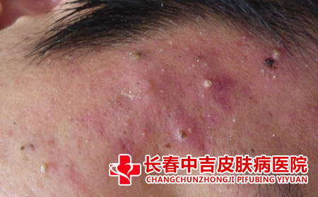 长春治疗痤疮的医院 