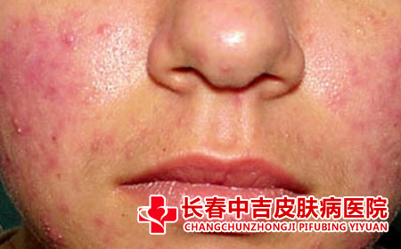 长春中吉看痤疮不错吗?