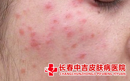 长春中吉皮肤病医院治疗痘痘好吗