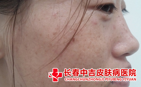 长春中吉皮肤病医院治雀斑吗