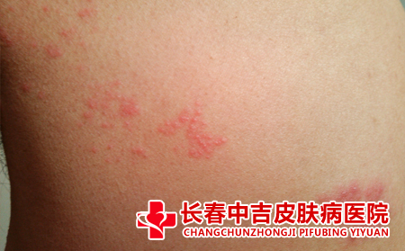 皮肤瘙痒应该怎么护理