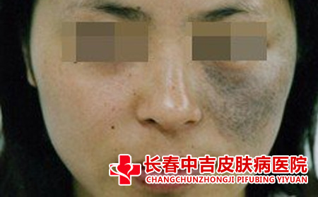 太田痣应该怎么进行护理