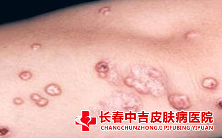扁平疣应该怎么进行护理