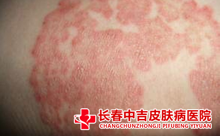 皮肤瘙痒应该怎么进行护理