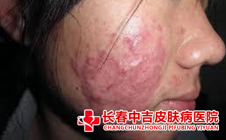 痤疮应该怎么进行护理