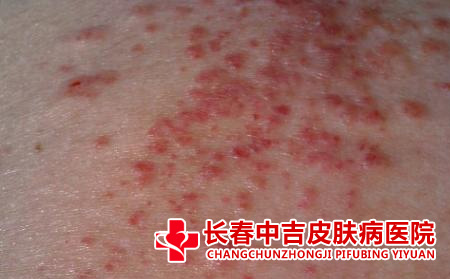 皮肤瘙痒应该怎么进行护理