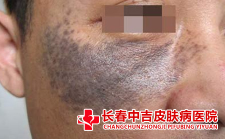 太田痣对患者有什么危害