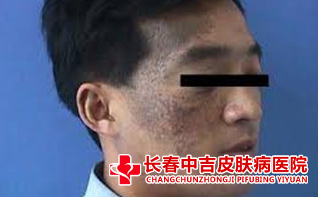 太田痣应该去哪里治疗