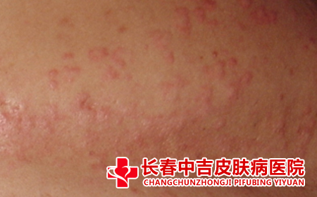 荨麻疹应该怎么进行护理