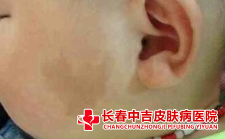 咖啡斑的危害有什么