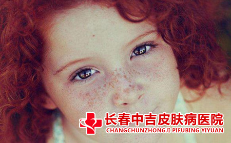 雀斑应该怎么进行护理