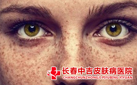 雀斑应该怎么进行治疗