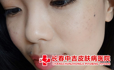 雀斑的护理方法有什么