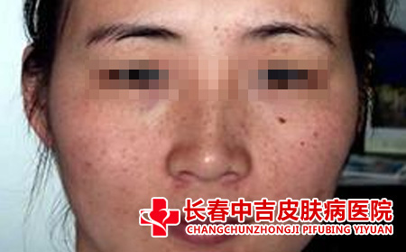 雀斑应该怎么进行护理