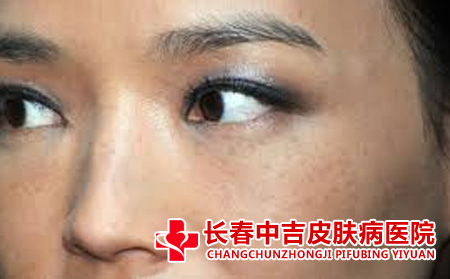 雀斑对患者有什么危害