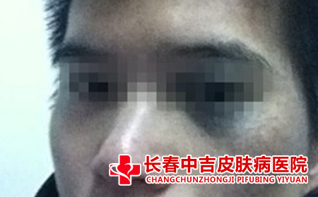 太田痣应该怎么进行护理