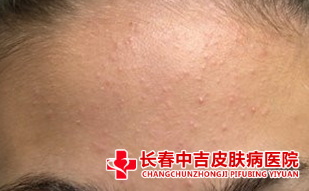 痤疮对患者的危害有什么