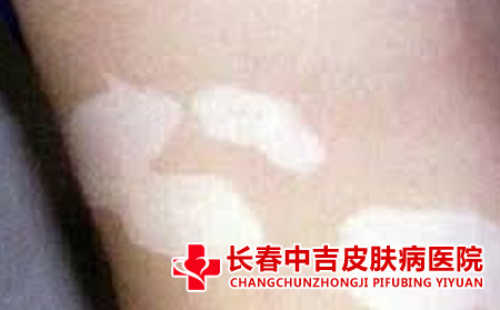 白癜风的护理方法有什么