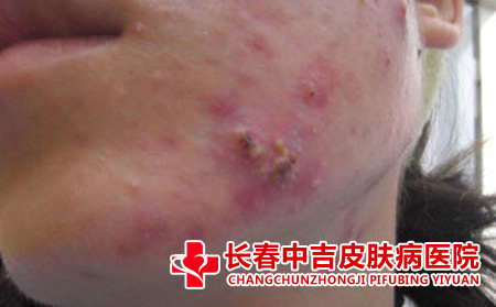 痤疮应该怎么进行护理