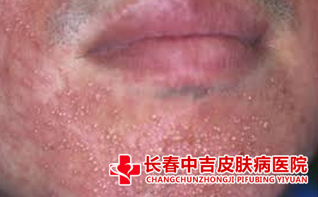 痤疮的护理方法有什么