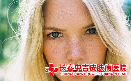 雀斑应该怎么进行护理