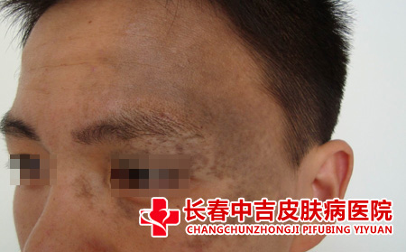 太田痣对患者有什么危害