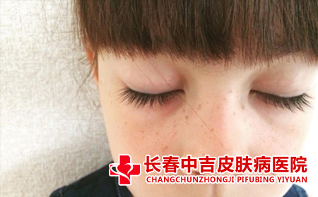 雀斑对患者有什么危害