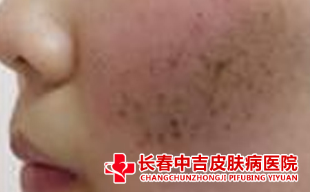 雀斑在生活中应该注意什么