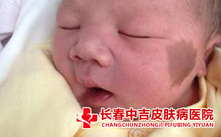 太田痣应该怎么进行护理