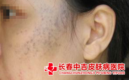 太田痣应该怎么进行护理
