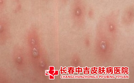荨麻疹怎么进行护理