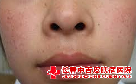 雀斑应该怎么进行预防