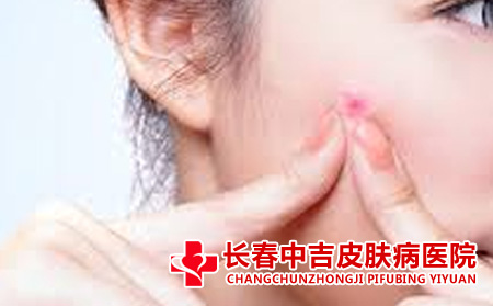 痤疮的护理方法有什么