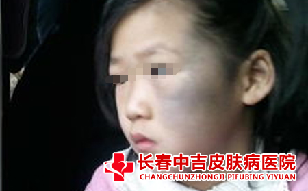太田痣患者应该注意什么