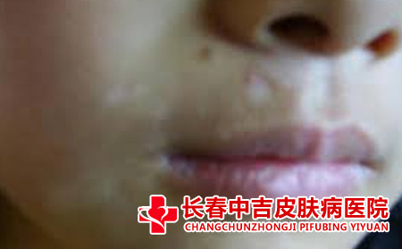 白癜风初期症状