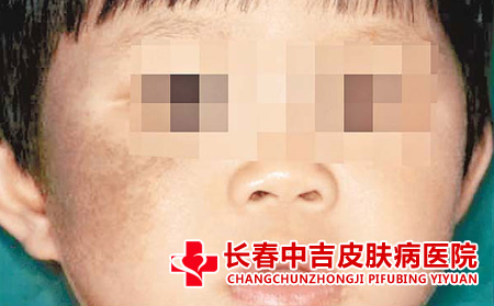 太田痣的症状有哪些
