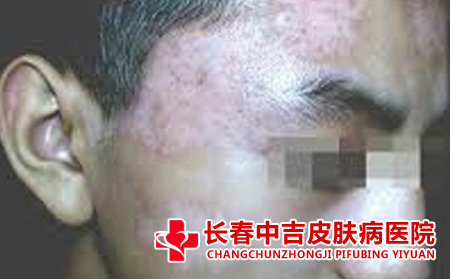 男性白癜风的发病原因