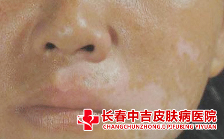 白癜风会扩散吗