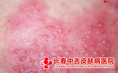 湿疹症状