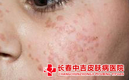 面部扁平疣的原因