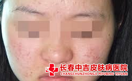 怎么预防痤疮