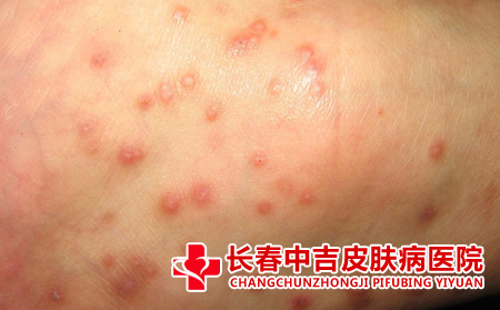 湿疹的症状