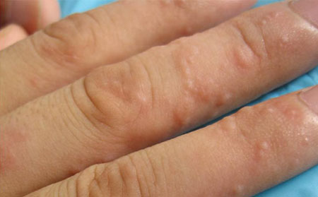 手部皮肤瘙痒症状