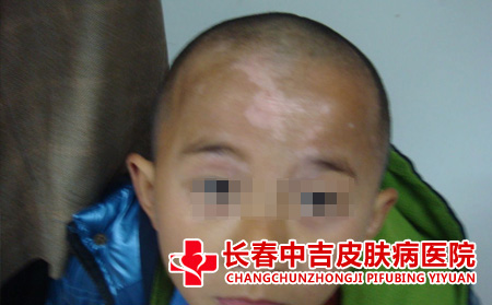 儿童白癜风的病因