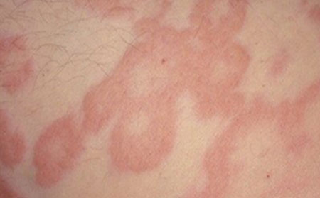 皮肤瘙痒症症状